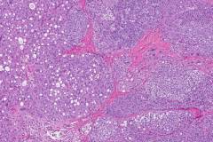 Sertoli cell tumour of the testis