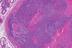 Sertoli cell tumour of the testis