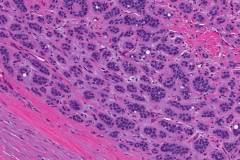 Sertoli cell tumour of the testis