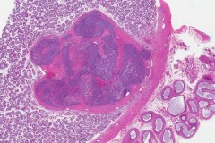 Sertoli cell tumour of the testis