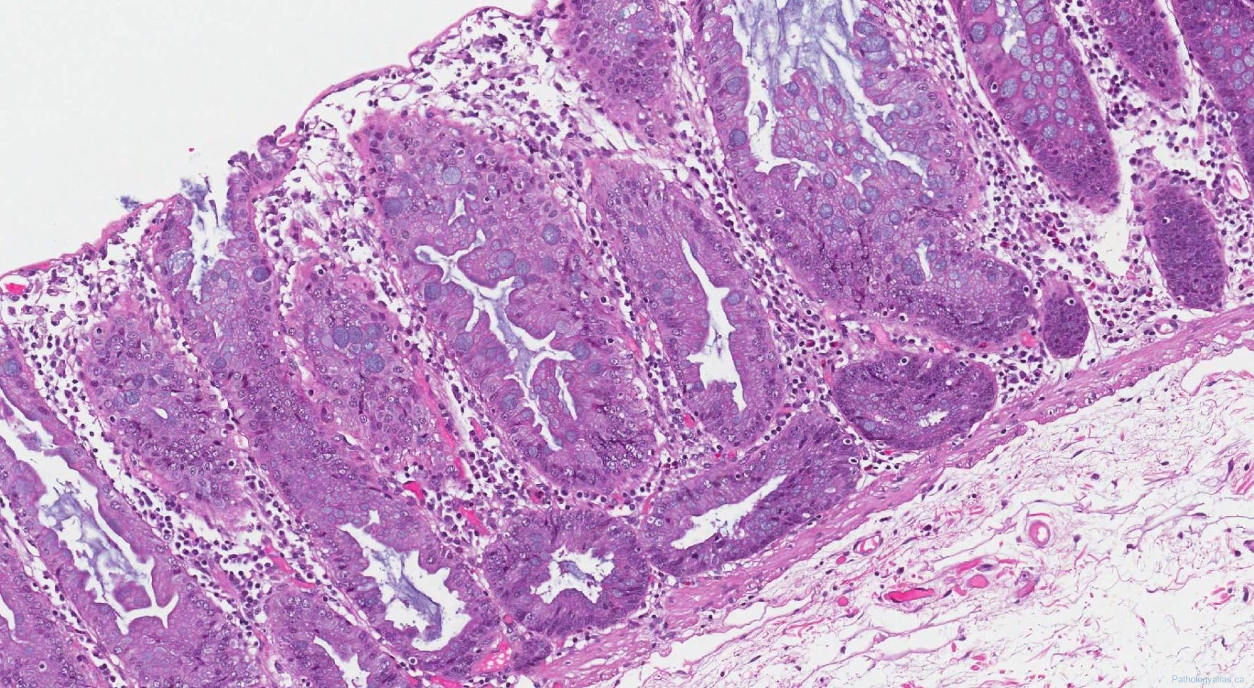 Sessile serrated lesion of the colon | Atlas of Pathology