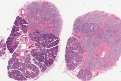 Chronic obstructive sialadenitis