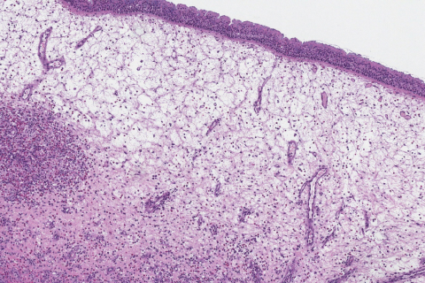 Sinonasal inflammatory polyp | Ottawa Atlas of Pathology