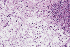 Sinonasal inflammatory polyp