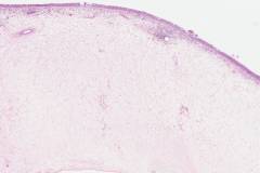 Sinonasal inflammatory polyp