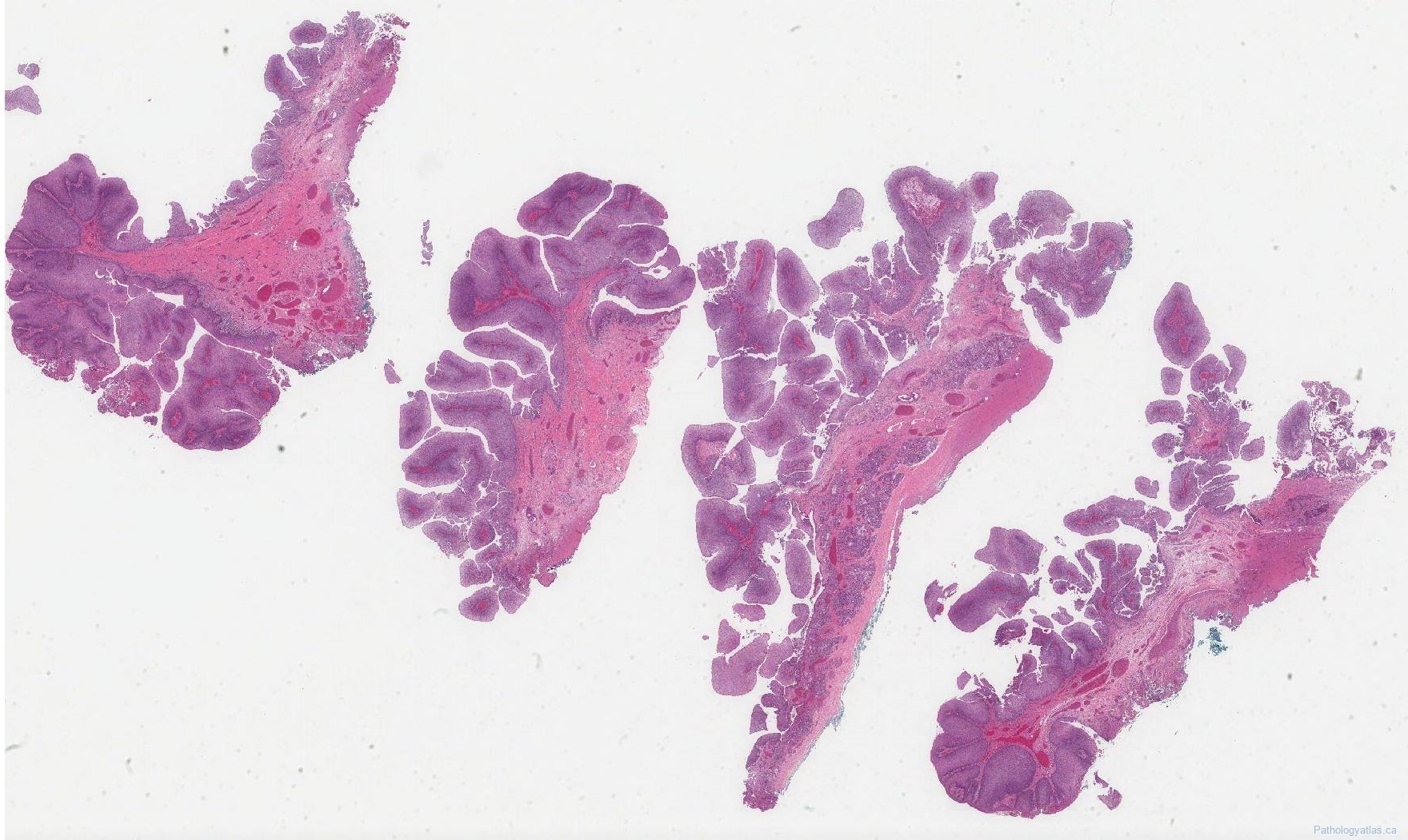 Schneiderian Papilloma Archives Atlas Of Pathology