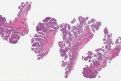 Exophytic sinonasal papilloma