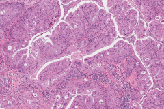 Oncocytic sinonasal papilloma