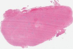 Nasopharyngeal angiofibroma