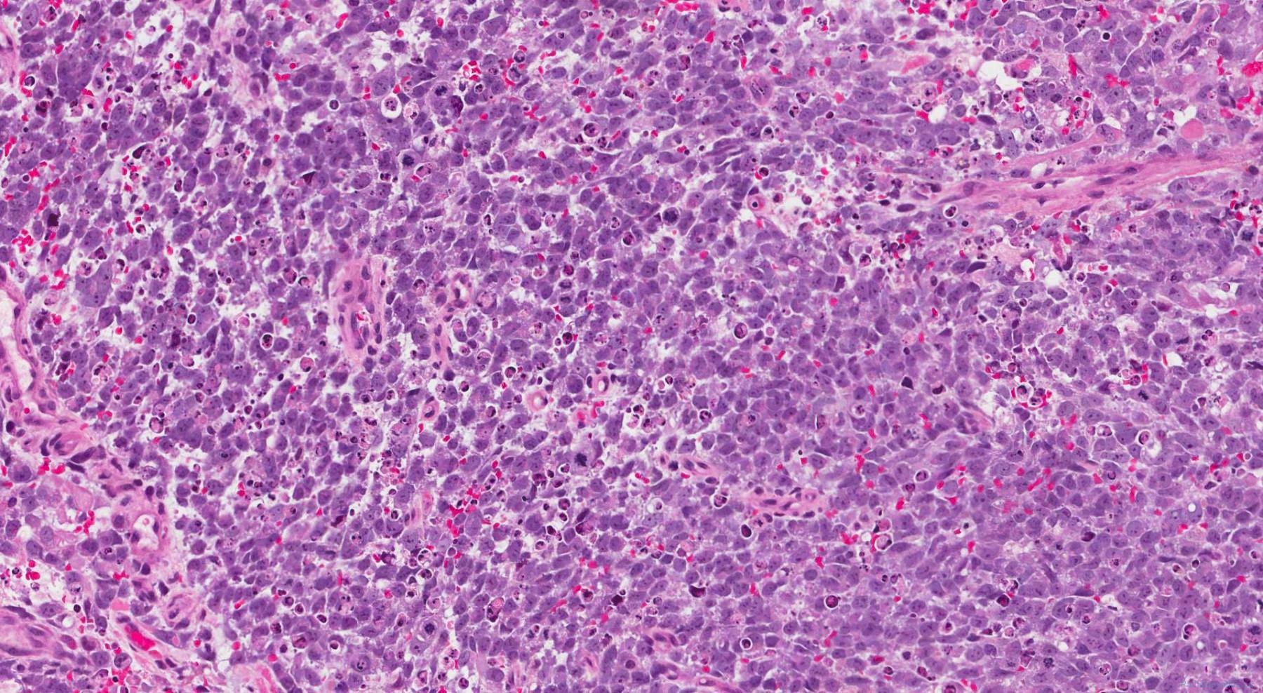 Sinonasal undifferentiated carcinoma | Atlas of Pathology