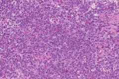 Sinonasal undifferentiated carcinoma