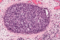 Sinonasal undifferentiated carcinoma