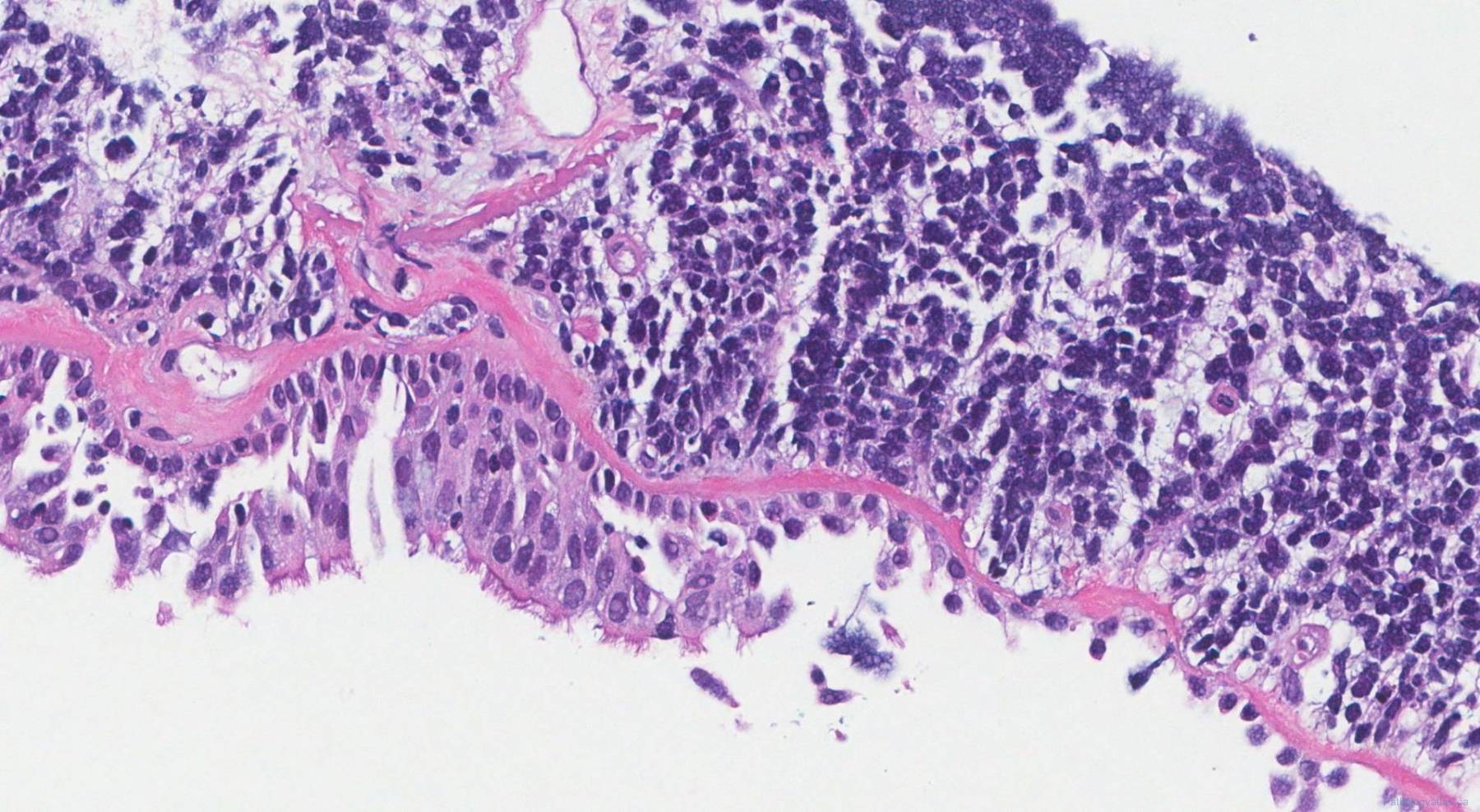 small-cell-neuroendocrine-carcinoma-of-the-lung-atlas-of-pathology