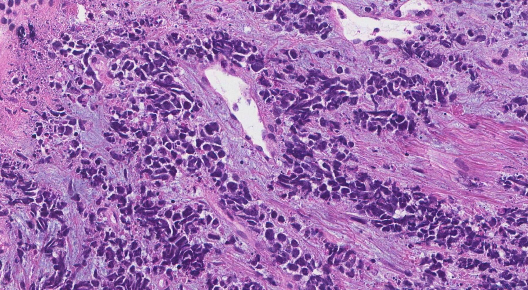 Small cell neuroendocrine carcinoma of the lung | Atlas of Pathology