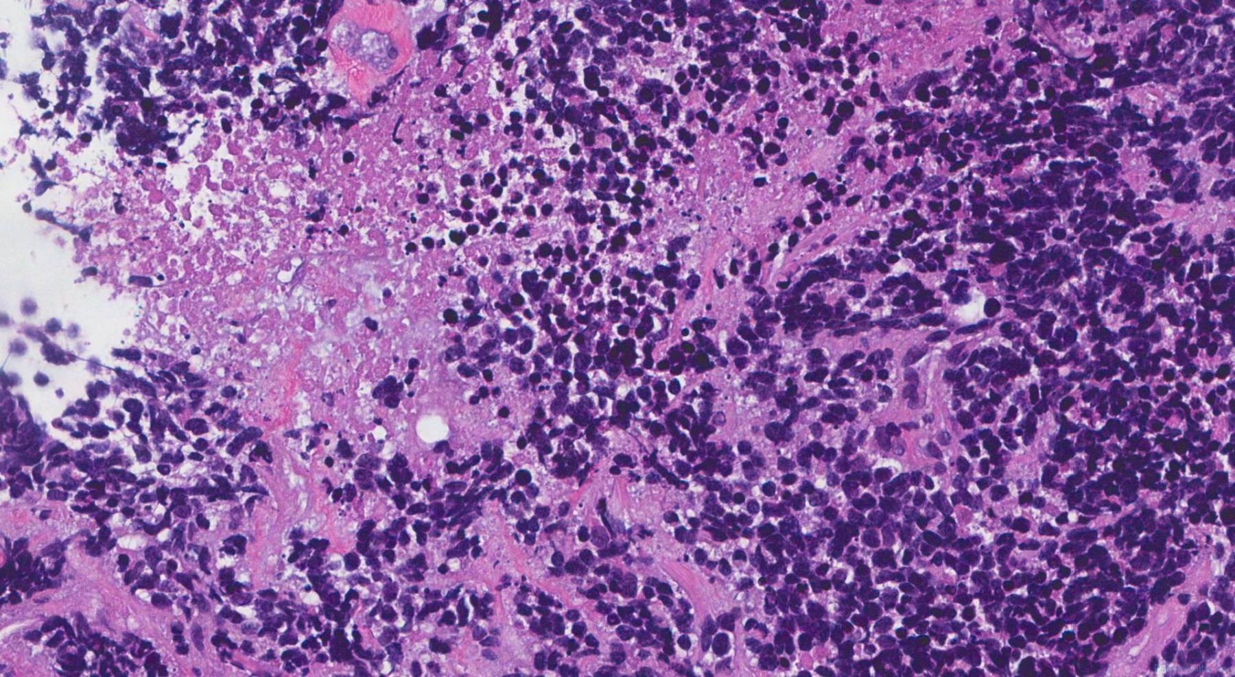 Small cell neuroendocrine carcinoma of the lung | Atlas of Pathology