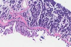 Small cell neuroendocrine carcinoma of the lung