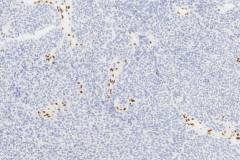 SMARCB1-deficient sinonasal carcinoma: Loss of INI1 protein expression