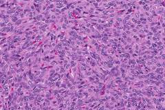 Solitary fibrous tumour