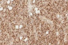 Fat-forming solitary fibrous tumour with high risk features: STAT6 reactivity