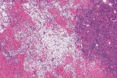 Solitary fibrous tumour