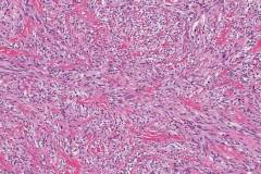 Solitary fibrous tumour