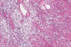 Solitary fibrous tumour