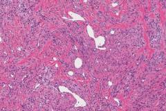 Solitary fibrous tumour