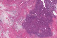 Solitary fibrous tumour