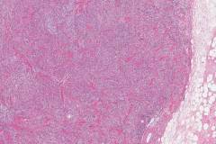 Solitary fibrous tumour