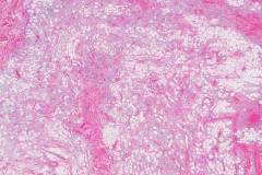 Solitary fibrous tumour