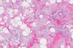 Solitary fibrous tumour