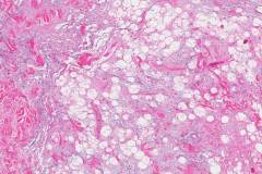 Solitary fibrous tumour