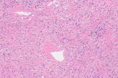 Solitary fibrous tumour