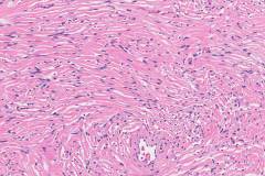 Solitary fibrous tumour