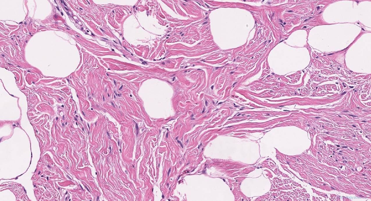 Spindle Cell Lipoma Atlas Of Pathology