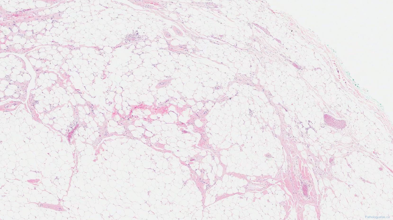 Spindle Cell Lipoma Atlas Of Pathology