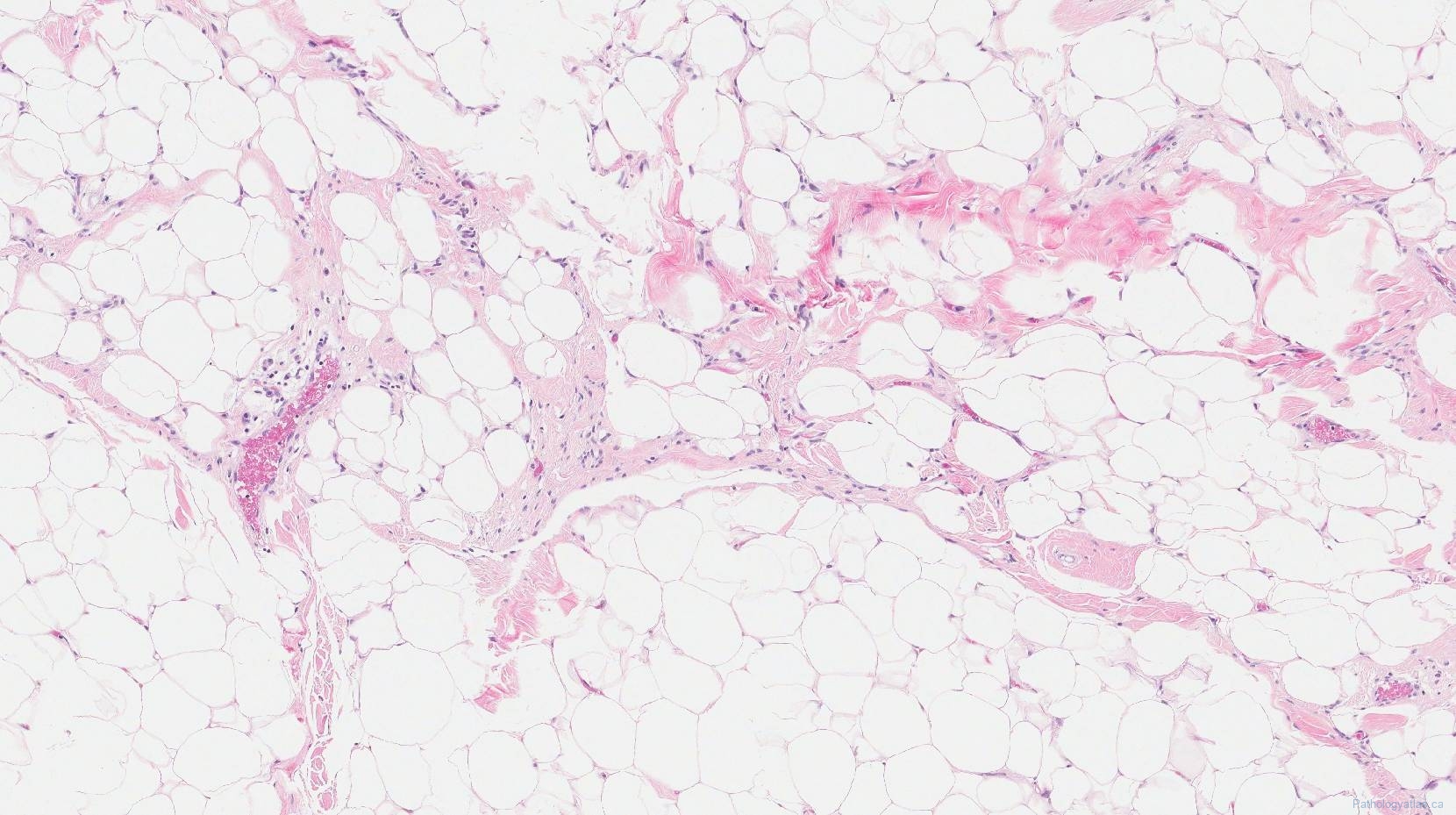 Spindle cell lipoma Atlas of Pathology