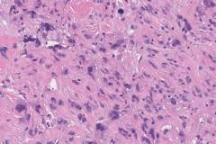 Spindle cell squamous cell carcinoma