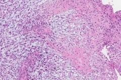 Spindle cell squamous cell carcinoma of the larynx