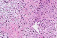 Spindle cell squamous cell carcinoma of the larynx