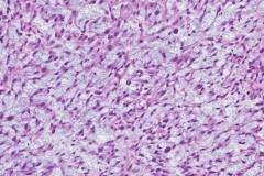 Spindle cell squamous cell carcinoma of the larynx