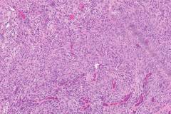 Spindle cell squamous cell carcinoma of the larynx