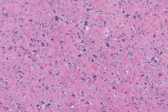 Spindle cell squamous cell carcinoma of the larynx