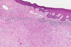 Spindle cell squamous cell carcinoma of the larynx