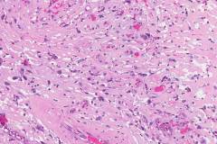 Spindle cell squamous cell carcinoma of the larynx