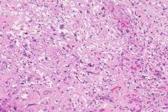 Spindle cell squamous cell carcinoma of the larynx