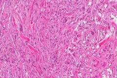 Spindle cell squamous cell carcinoma of the larynx