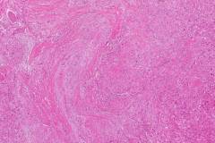 Spindle cell squamous cell carcinoma of the larynx