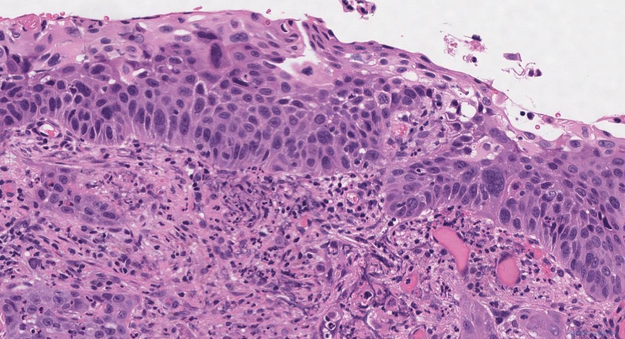 Squamous Cell Carcinoma Of The Larynx Ottawa Atlas Of Pathology