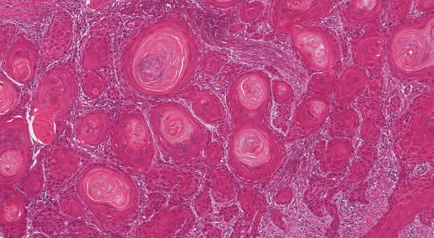 Squamous Cell Carcinoma Of The Larynx Ottawa Atlas Of Pathology 